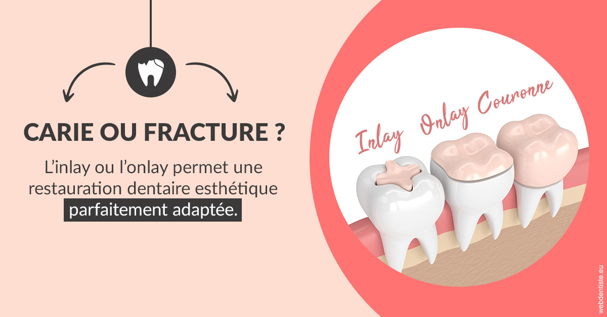 https://dr-khoury-georges.chirurgiens-dentistes.fr/T2 2023 - Carie ou fracture 2