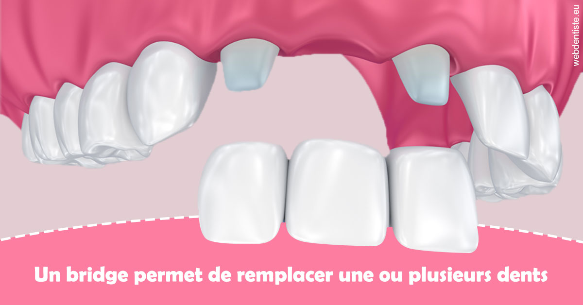 https://dr-khoury-georges.chirurgiens-dentistes.fr/Bridge remplacer dents 2