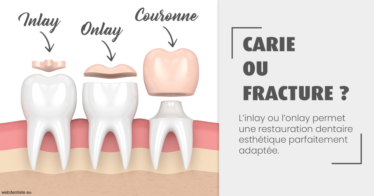 https://dr-khoury-georges.chirurgiens-dentistes.fr/T2 2023 - Carie ou fracture 1