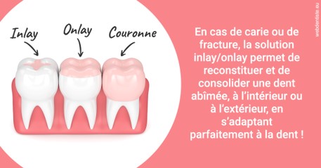 https://dr-khoury-georges.chirurgiens-dentistes.fr/L'INLAY ou l'ONLAY 2