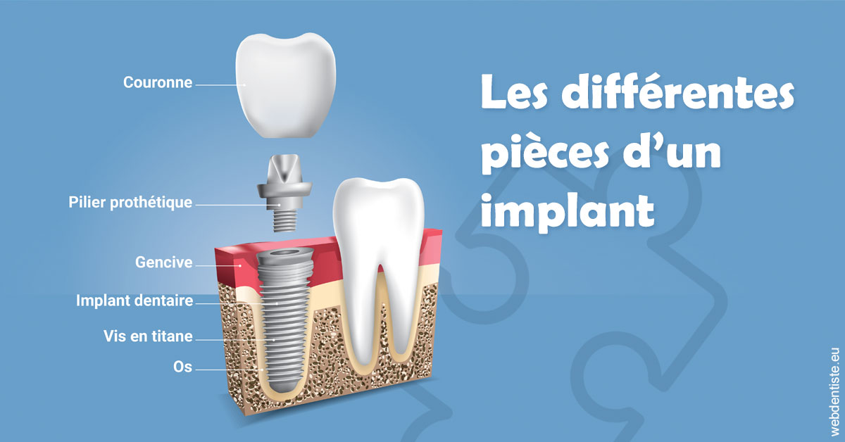 https://dr-khoury-georges.chirurgiens-dentistes.fr/Les différentes pièces d’un implant 1