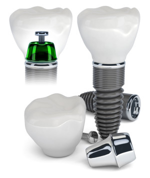Les implants dentaires un traitement fiable